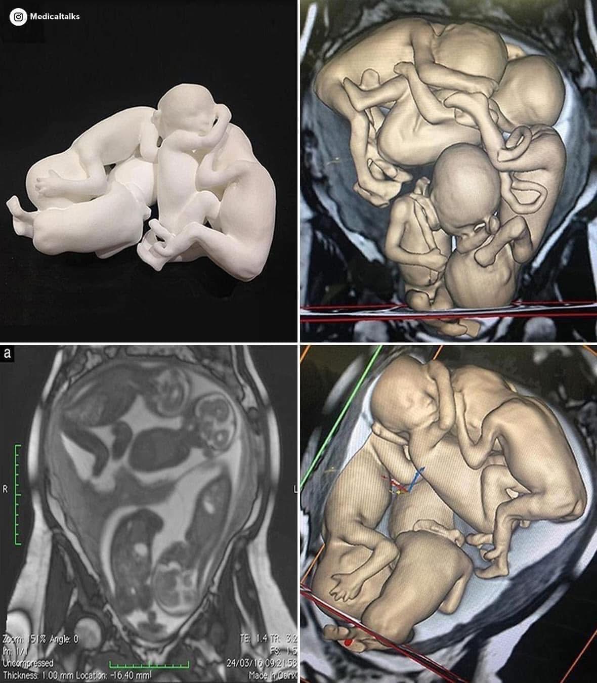 💫 Четыре сердца под одним ритмом: история уникальной многоплодной беременности после ЭКО